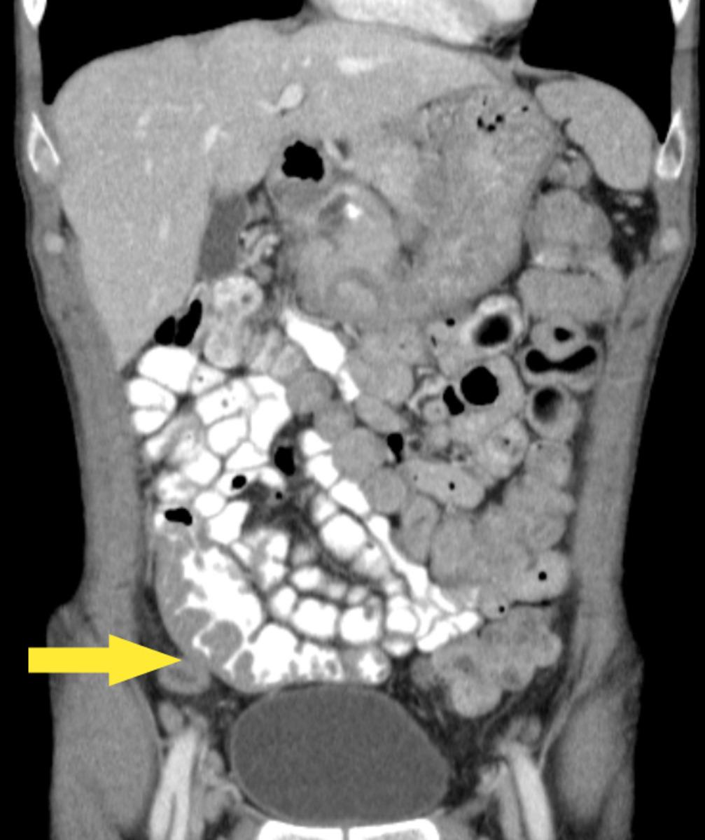 Fig. 19: Coronal CT slice illustrating diffuse polypoid mural change.