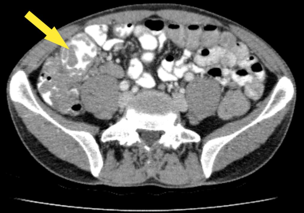 Fig. 20: Axial CT slice illustrating diffuse polypoid mural change.