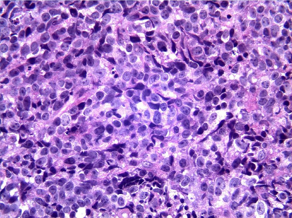 Fig. 2: Diffuse large B cell lymphoma (DLBCL): large tumour cells with vesicular chromatin, prominent nucleoli and moderate to abundant amount of cytoplasm (H&E, 400 ).