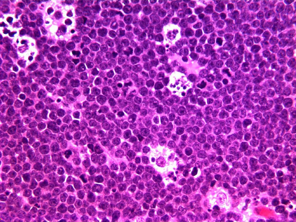 Fig. 3: Burkitt lymphoma: characteristic 'starry sky' appearance and frequent mitotic figures (H&E, 400 ).