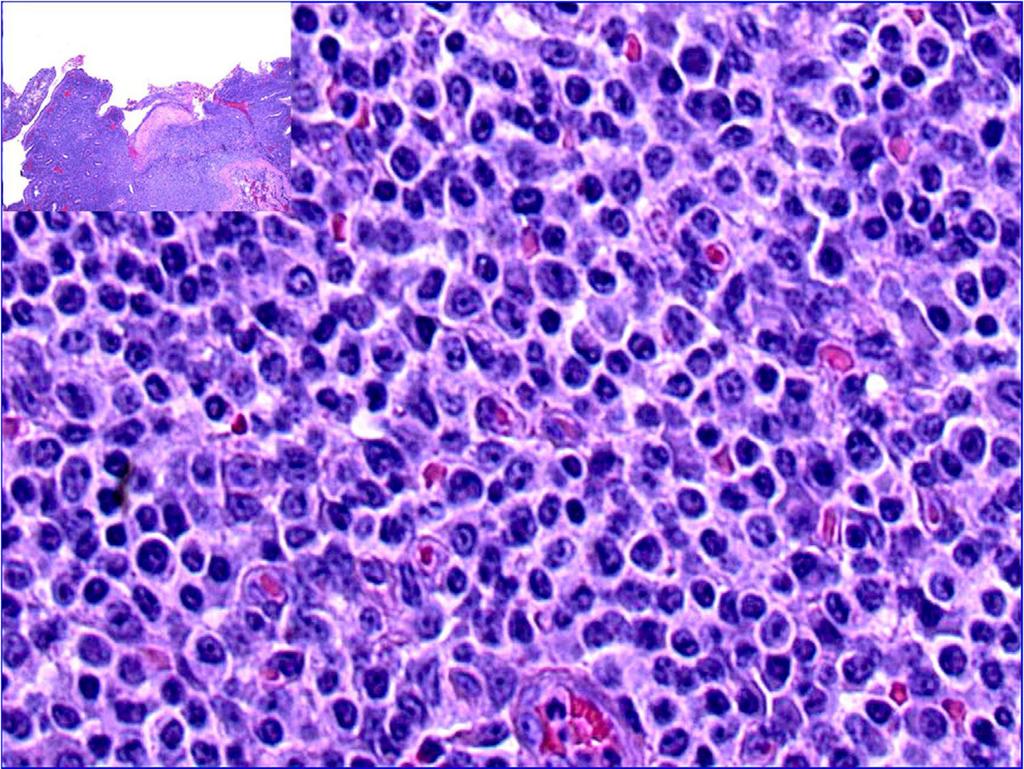 Fig. 4: Enteropathy associated T-cell lymphoma (EATCL): monomorphous, neoplastic lymphoid infiltrate (H&E, 500 ). The inset image (upper left, H&E, 20 ) demonstrates involvement of surface epithelium.