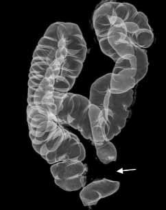 CT Colonography Chapter 2 31 Pseudopolyp Case 8 Indication/Clinical symptoms This woman
