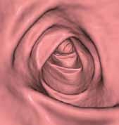 elongated colon (approx. 150 cm).