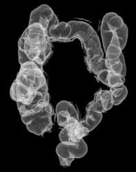 CT Colonography Chapter 2 33 Polyp after intravenous administration of contrast medium Case 9