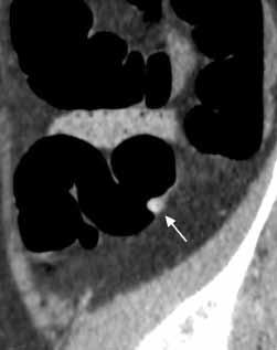 a CT colonography. Elongation of the sigmoid colon and diverticulosis were known to exist.