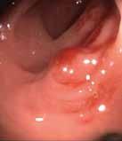 34 Chapter 2 CT Colonography Findings on colonoscopy Exactly at the site ascertained by virtual colonography, above the iliac wing at the junction between the