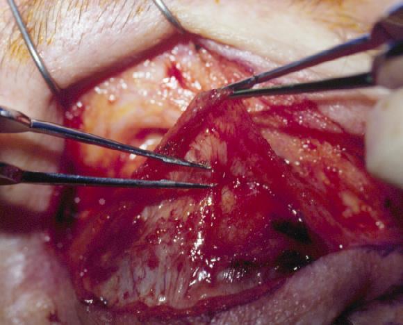 PTOSIS REPAIR Ptosis Repair surgical options External Ptosis Repair (levator surgery) Internal Ptosis Repair