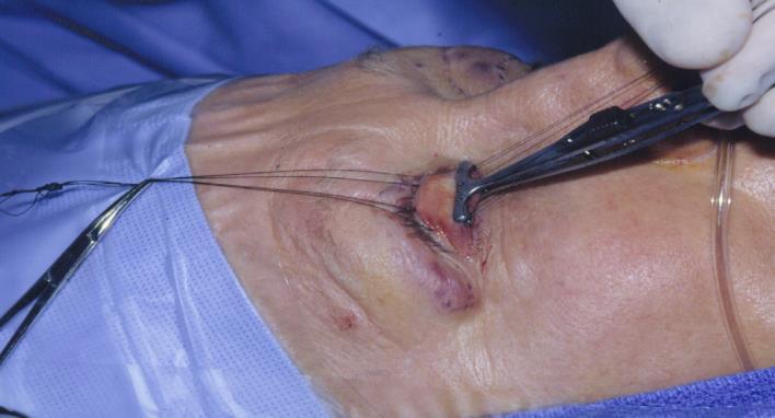 Conjunctival-Muller Resection post-operative