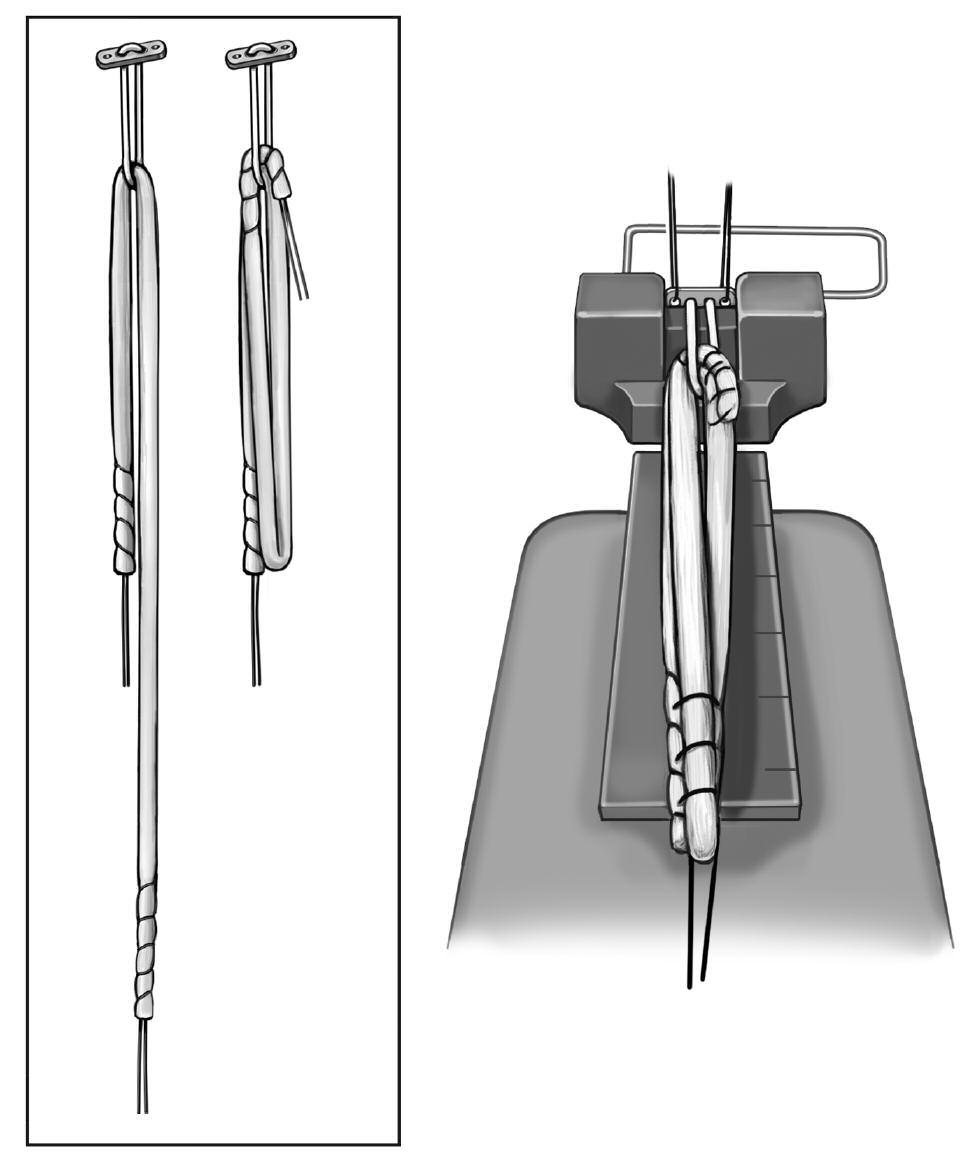 Tricks and Tips Triple Stranded Graft Preparation It is always possible to utilize a triple stranded PL graft, due to its short intra-articular length.