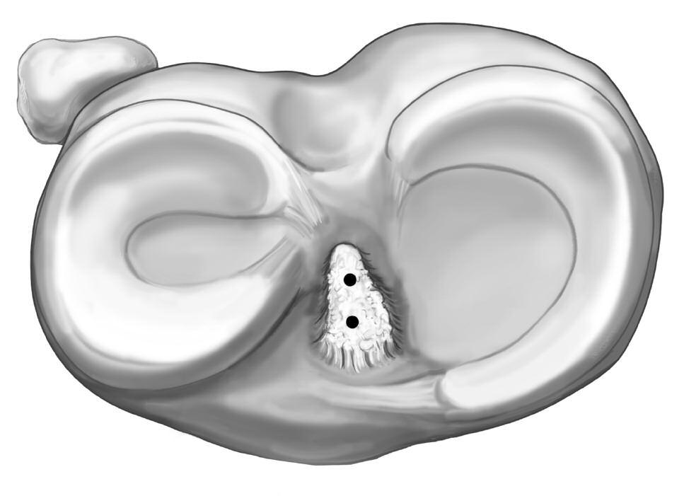 The size of the ENDOBUTTON CL should be chosen to ensure that at least 15 mm of graft remains within the femoral tunnels.