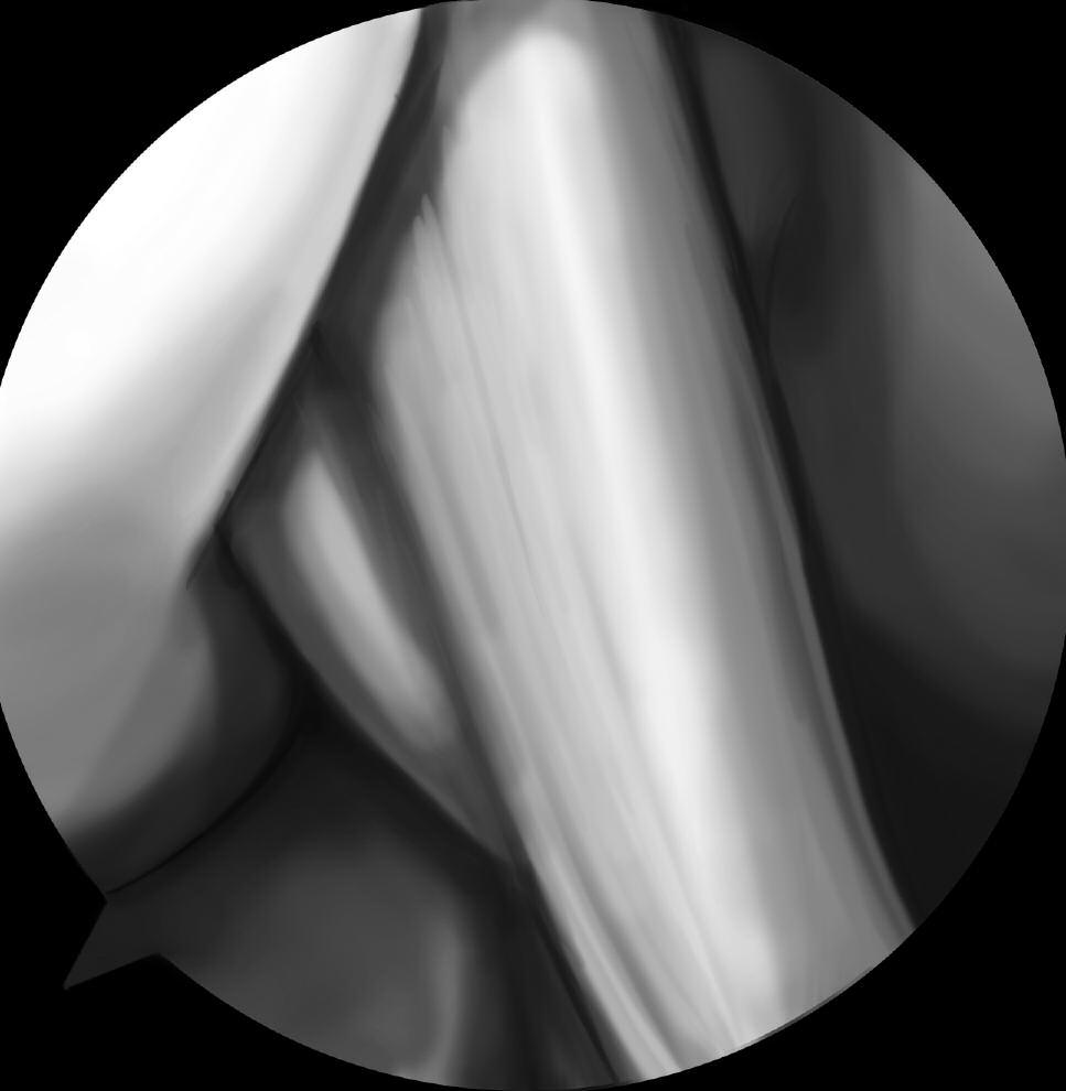 Anatomic ACL Reconstruction using the Smith & Nephew ENDOBUTTON CL Fixation System Introduction Anatomical and biomechanical studies have shown that the anterior cruciate ligament (ACL) consists of