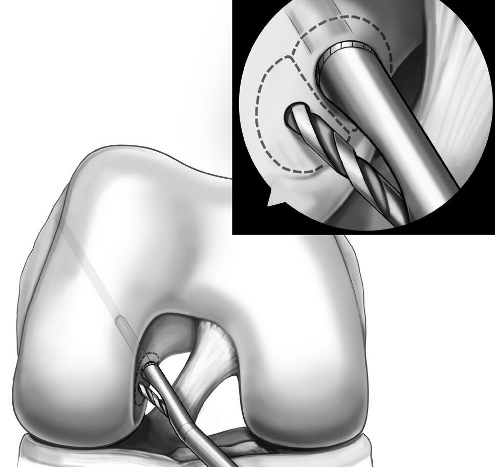 Figure 6 Drilling the PL Tunnel and Socket Posterolateral Tunnel Keeping the knee flexed to 120, insert the Smith & Nephew Anatomic ACLR PL Femoral Aimer with an appropriately-sized post into the AM