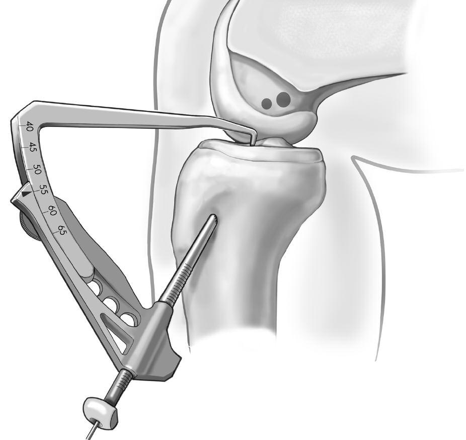 Drilling the Tibial Tunnels Anteromedial Tunnel Identify the anatomic insertion of the AM and PL bundles of the ACL on the tibia. Mark these insertion sites with either an RF probe or an awl.