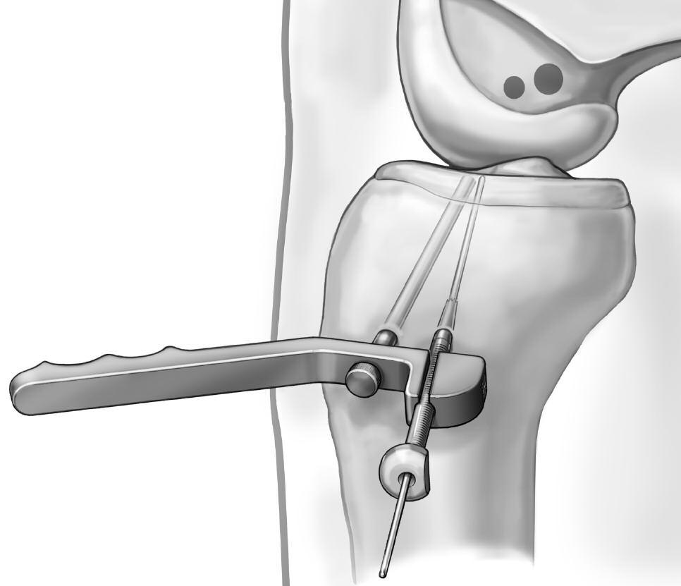 An osseous bridge of approximately 2 to 3 mm should remain between the two tunnels inside the joint (Figure 13). Final Graft Passage and Fixation Use a 2.