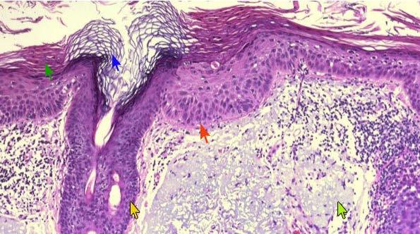 HISTOLOGIC FEATURES Actinic keratosis is characterized by dysplasia and architectural disorder of the epidermis, as follows: Abnormal keratinocytes of the basal layer that are variable in size and