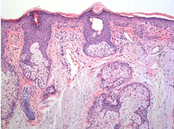 The epidermis shows mild hyperkeratosis with dysplasia of the basal keratinocytes and formation of small buds extending into the
