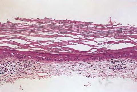 In the atrophic type of actinic keratosis, hyperkeratosis usually is slight and the epidermis is thinned and devoid of rete ridges.