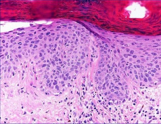 The bowenoid type of actinic keratosis is histologically indistinguishable from