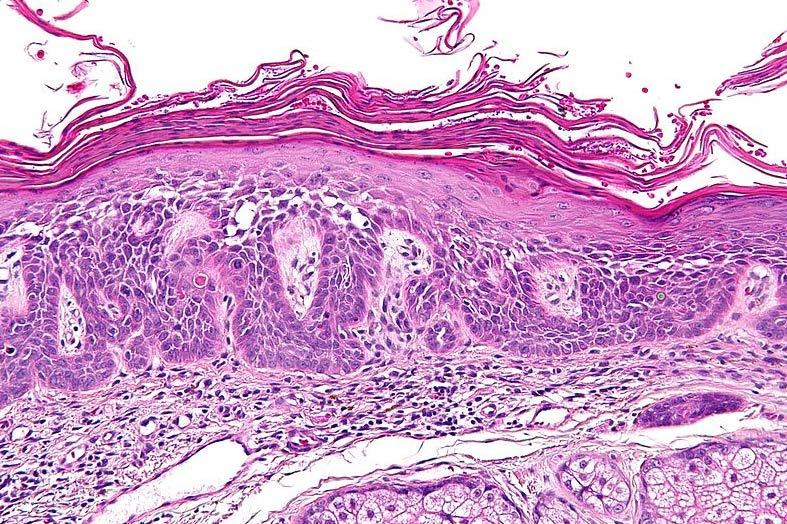 As in Bowen's disease, there are full thickness changes within the epidermis with