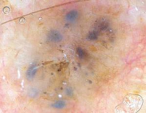 Large blue - gray ovoid nests are well circumscribed confluent or near confluent pigmented ovoid