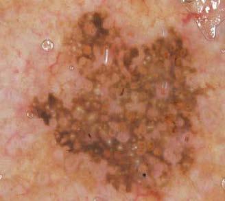 Pigmented seborrheic keratosis on the face Pigmented seborrheic keratosis on the face is distinguished by a typical
