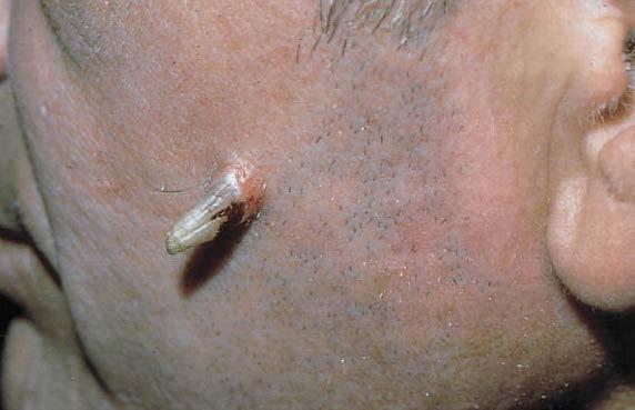 pinhead to a pencil eraser, and the shape may be straight or curved. Sometimes skin cancer hides below a cutaneous horn.