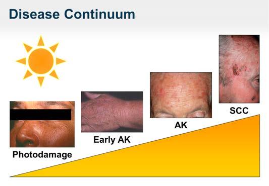 DOES AK UPGRADE IN A SKIN CANCER?