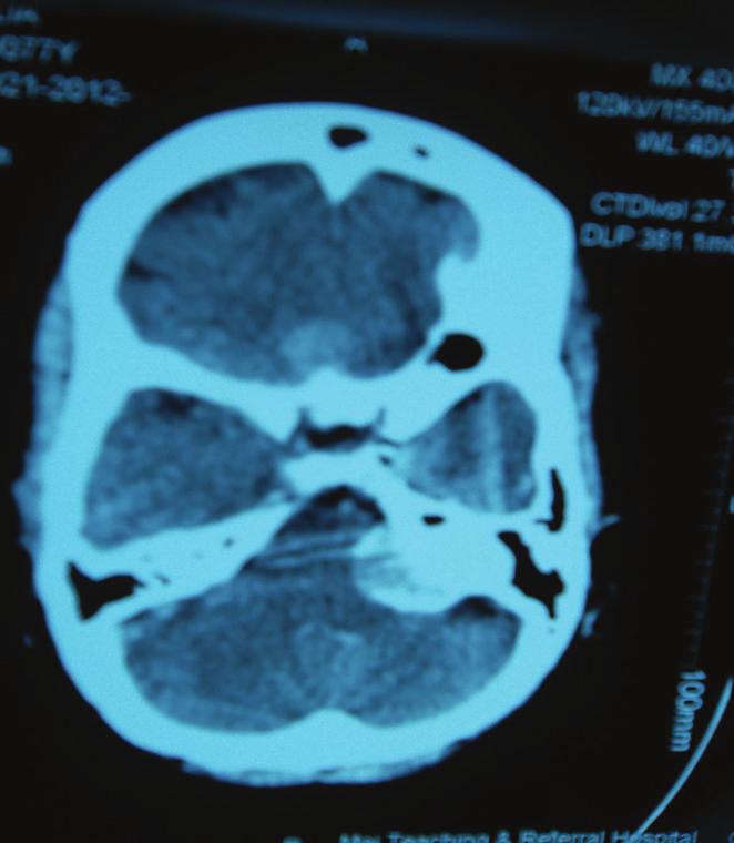 2 Case Reports in Surgery Figure 1: Axial CT scan of the head showing a meningioma in the left CP angle and another in the tuberculum sella. 3.