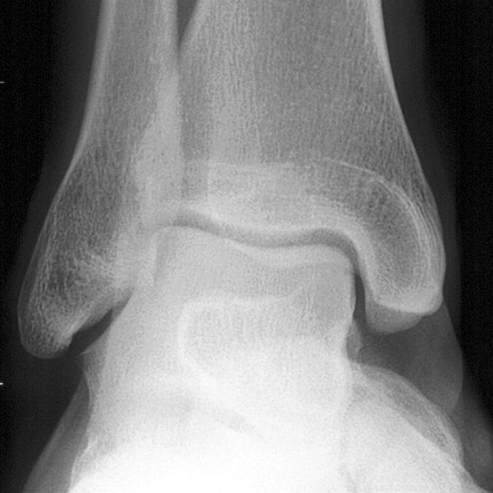 KISSING CONTUSIONS A B C Figure 1. 31-year-old man two weeks after sprain. A, Anteroposterior radiograph of the right ankle shows no abnormalities.