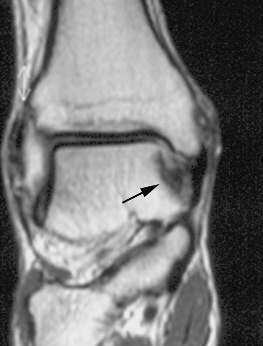 Only six of the 12 talar fractures and none of the tibial fractures involving the 26 ankles were visualized by conventional radiography.