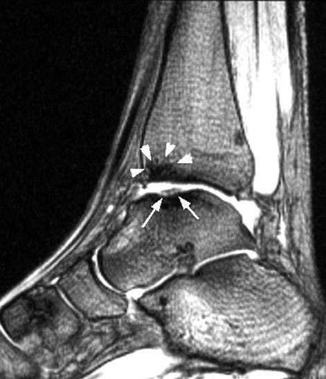 (arrow). C, Sagittal T1-weighted spin-echo (TR/TE 600/23) MR image shows osteochondral fracture in medial talar dome (arrows) and bone contusion in tibia plafond (arrowheads).