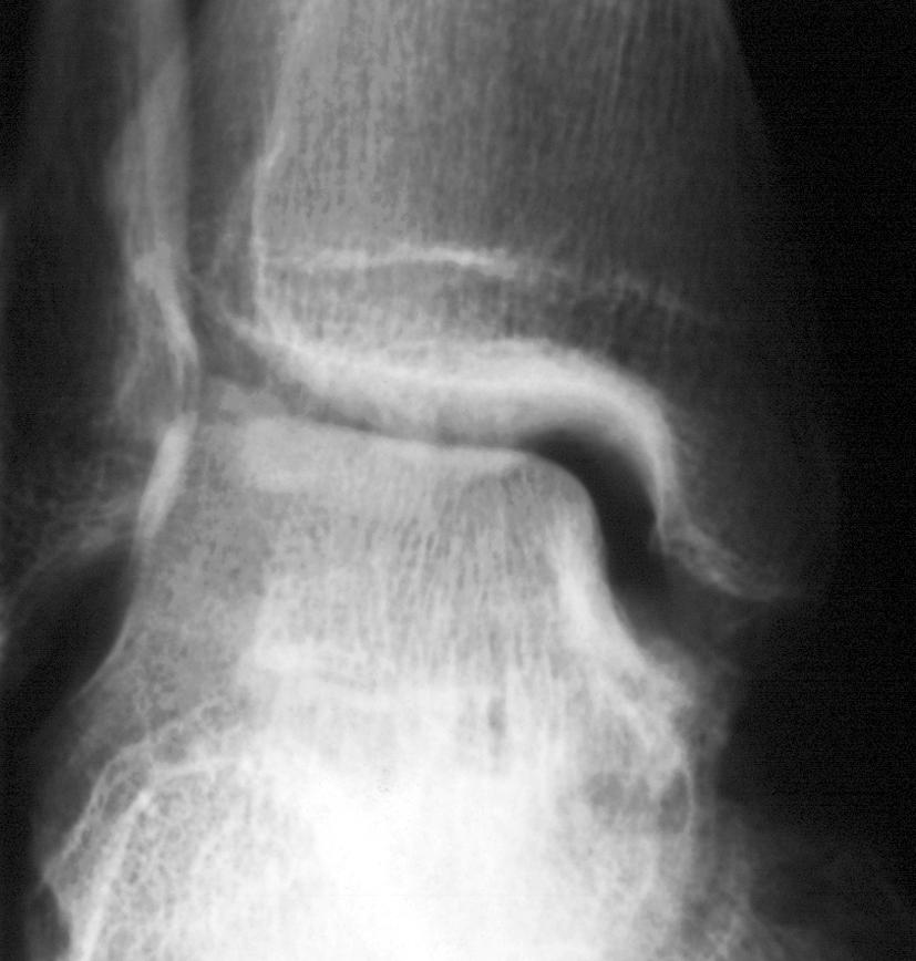 K ISSING A Figure 3. 42-year-old man with persistent pain after recurrent sprains of right ankle. A, Anteroposterior radiograph of ankle shows osteochondral defect in lateral aspect of talus (arrow).