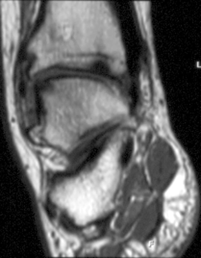 CONTUSIONS B C intensity line by T2-weighted imaging extending through the cortical surface. The subchondral abnormalities are believed to be caused by trauma that causes impaction of the bones.