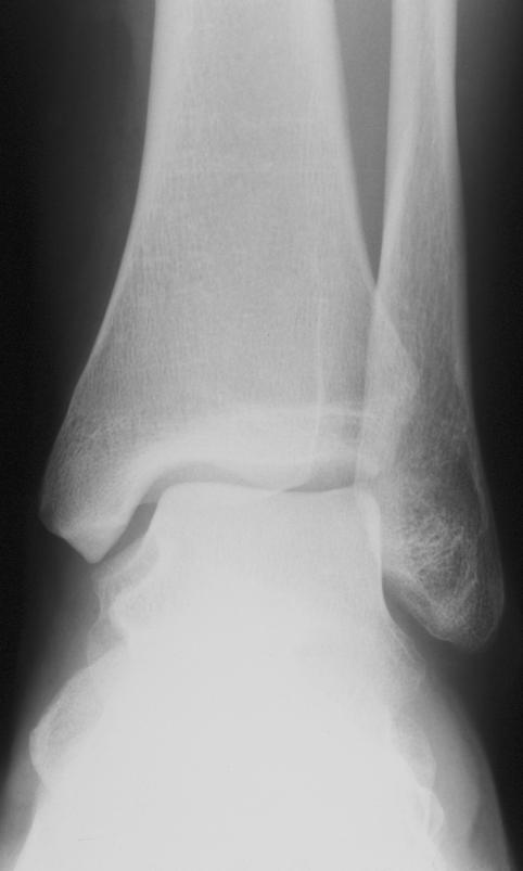 C HAPTER 7 A B C Figure 4. 25-year-old male 7 weeks after severe sprain of left ankle. A, Anteroposterior radiograph of left ankle shows no abnormalities.