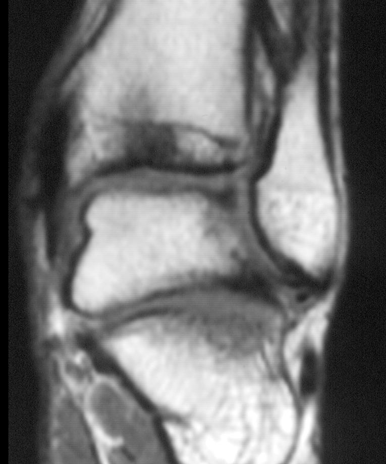 Contusions are not diametrically opposed probably as result of rotation. due to ligamentous injury and recurrent sprains may also be responsible for the persisting bone marrow edema in the ankle.