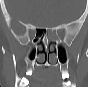 the antrum Note left choncha bullosa and left deviated nasal septum. Fig. 3. Coronal CT.