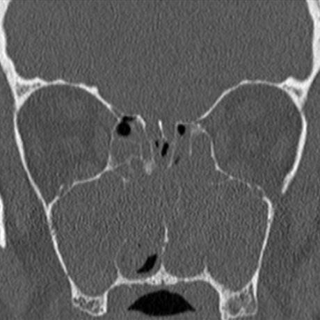 anterior ethmoid cells ethmoid infundibulum and maxillary sinus Note the infundibular pattern on the right