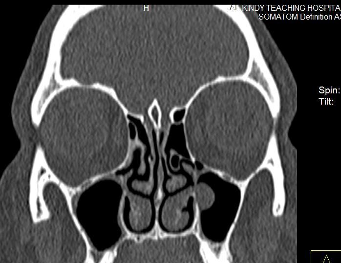 100 80 96 88 80 84 60 40 32 40 20 16 Fig. 5. Coronal CT. Sinonasal inflammatory disease of sporadic pattern in a patient with retention cyst in the left maxillary sinus.
