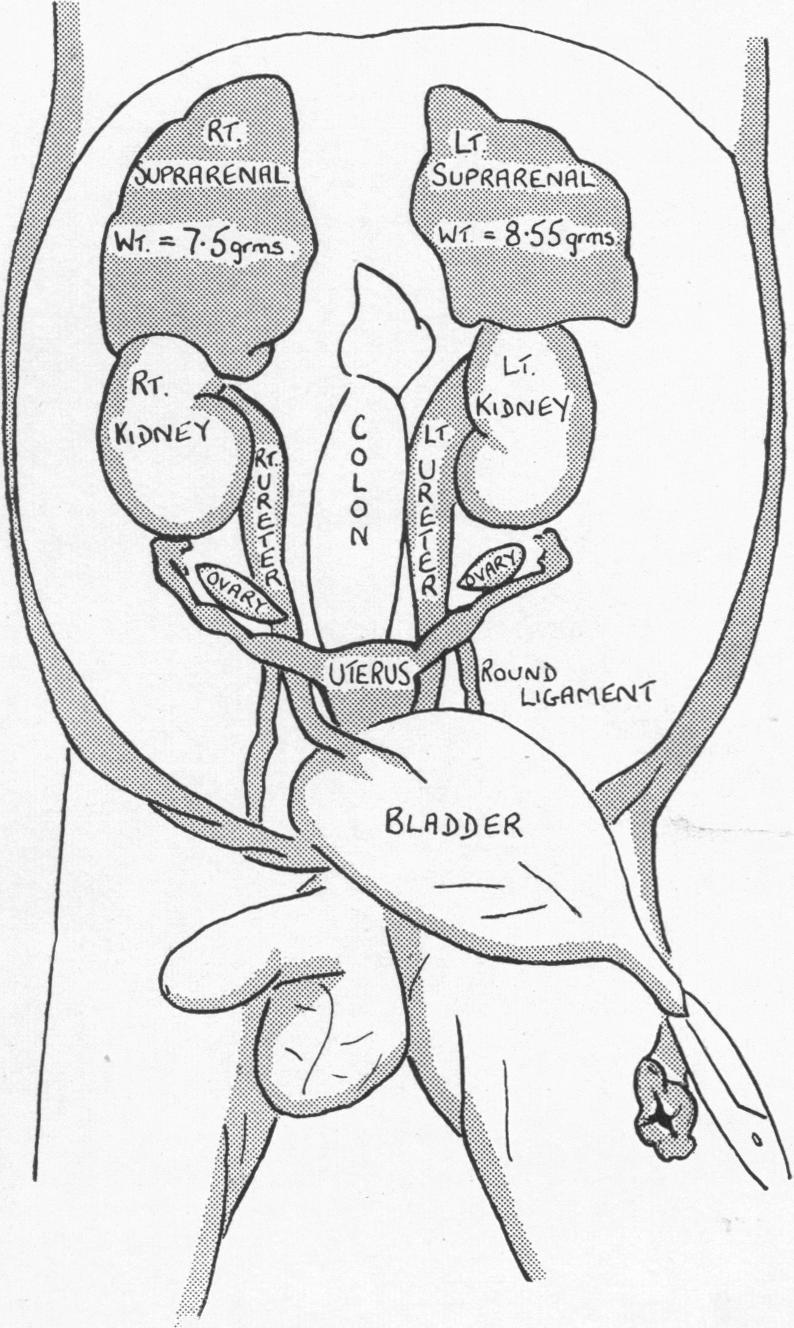 through to open into the FIG. 1.-Post-mortem photograph of abdominal viscera. posterior urethra at the verumontanum (Fig. 3).