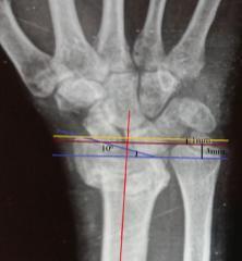 parameters taking odified Grahams radiological criteria for acceptable healing of distal radius [5] and competent neurological and vascular status of the limb.
