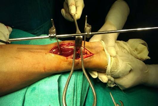 Ulnar shortening osteotomy required in one patient intraoperatively due to excessive positive ulnar variance causing difficulty achievement of