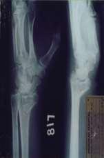 Figure 10: Die-punch fracture treated with