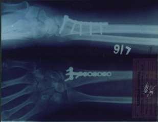 distal intra articula radius fracture.