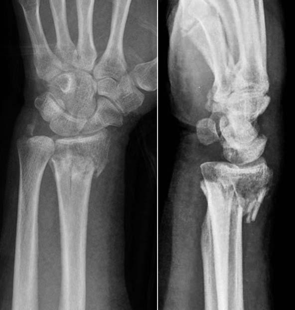 CASE REPORT A 59-year-old, right-handed female presented to the emergency department after a pedestrian traffic accident injury to her right wrist.
