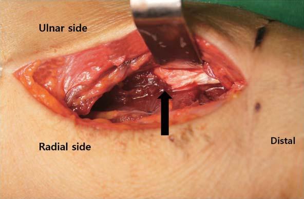 Our patient s laboratory Fig. 2. Intraoperative gross picture showing ruptured third flexor digitorum profundus tendon at the musculotendinous junction in flexor tendon zone V.