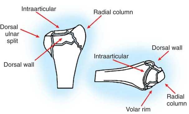 46 Figure-1 Distal radial anatomy Inset, Columnar classification of distal radius and ulna patients with unstable distal radius