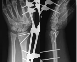 Figure-2 Distal Radial Fracture Elements Figure-3 Musculotendinous forces acting across the wrist tend to cause the Radial styloid