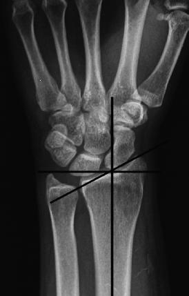 Figure-5A Radial inclination Figure-5 B Radial length Figure-5 C Ulnar variance Figure-5 D Volar tilt Fig-5 Normal average distal radial angles. A, Radial inclination (RI; average 22 degrees).