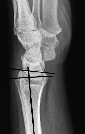 The age range 16 years to 70 years with mean age 48.54+16.36. 26 cases of fracture due to fall. Twenty cases were due to road traffic accident. All cases were unilateral.