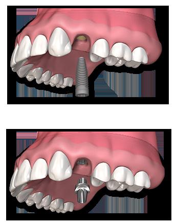 THE IMPLANT PROCEDURE Several steps are required for dental implants: The first step in the dental implant process (whether for a single implant or an All-on-4) is an assessment of the remaining